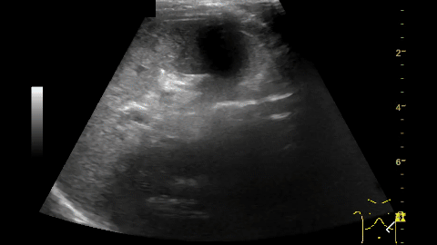 Milzverletzung_Blutung_Appendizitis_Aortendissektion