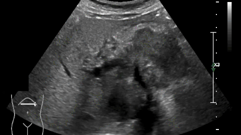 Pankreaskarzinom_Angiomyolipom_Hydronephrose_Ureterozele_Tumorthrombus