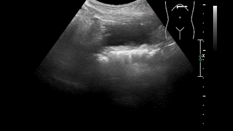 Perikarderguss_Crohn_Milzinfarkte_Harnstau_Pendelperistaltik